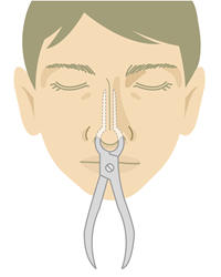 整復用の鉗子を鼻の中に挿入し骨折部を整復します。