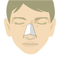 骨折の程度に応じて、シーネで1～2週間患部を保護します。また、鼻の中にガーゼを4日ほどつめて形を整えます。