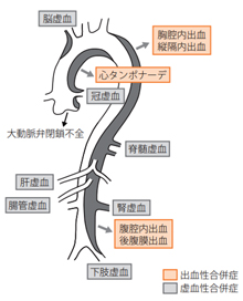 1.おそろしい大動脈解離の合併症