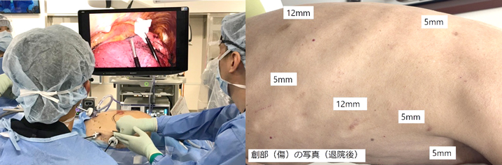 食道がんに対する胸腔鏡下食道切除術