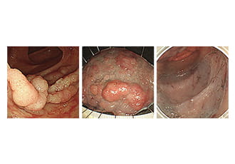 大腸 ESD（肝彎曲部）本体サイズ 62mm 断端陰性・治癒切断