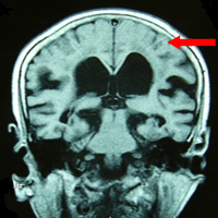 冠状断で円蓋部の脳溝が閉じているのが特長です