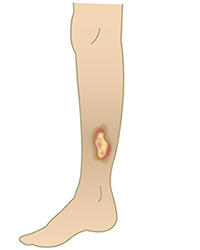 下肢難治性潰瘍