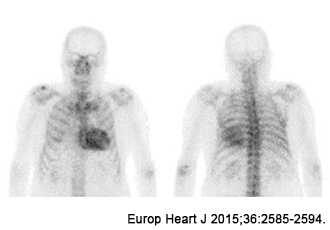 Pyrophosphoric myocardial scintigraphy