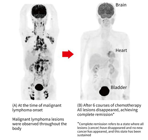 PET-CT images before and after malignant lymphoma treatment